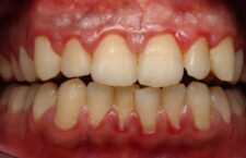 Ουλεκτομή: Βελτίωση Ουλικού Περιγράμματος των Δοντιών