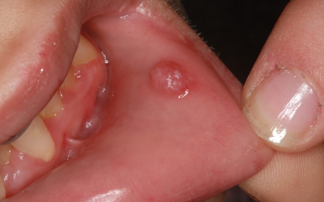 Βιοψία και ογκίδια στο στόμα